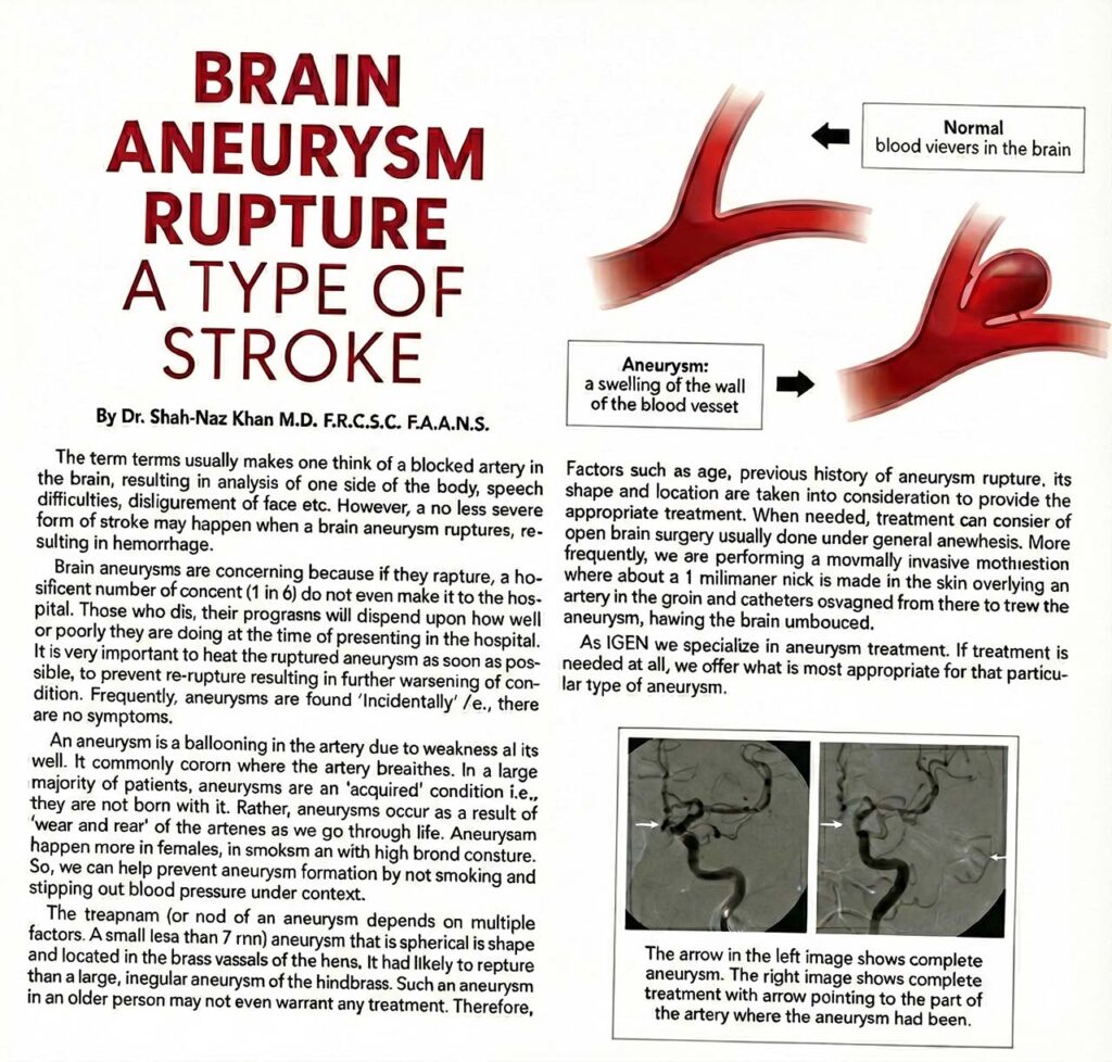 Scanned publication by Dr Shah-Naz Khan explaining brain aneurysm rupture as a type of stroke, with medical illustrations of aneurysm formation.